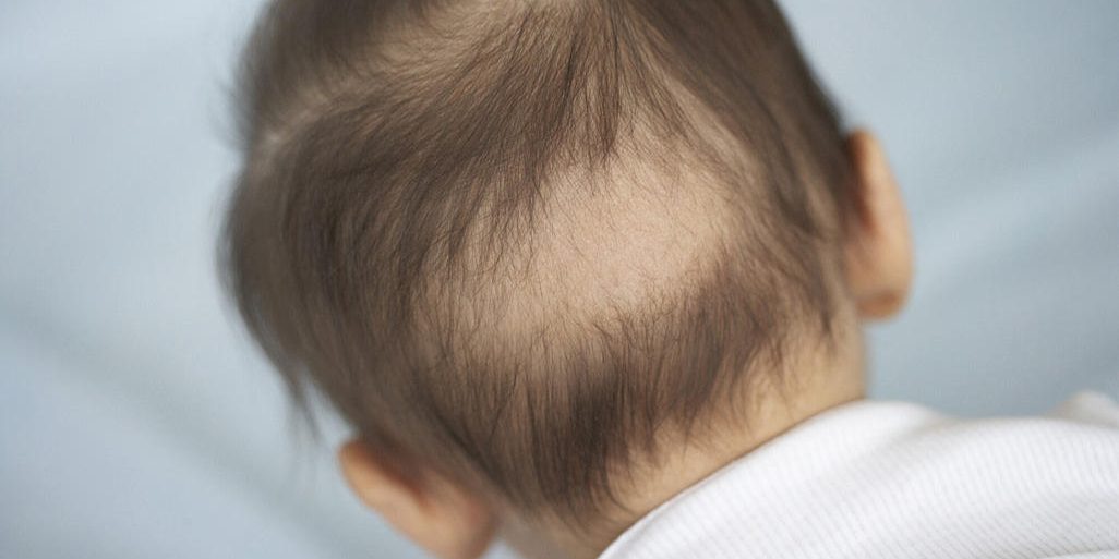 علت ریزش موی سر در کودکان